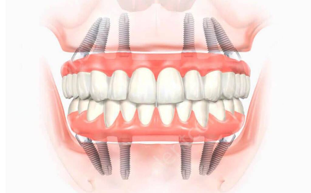Имплантация ALL-ON-6